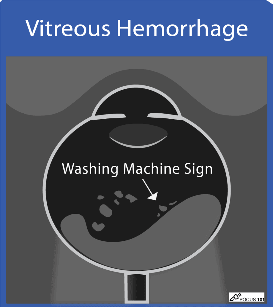 Ocular Ultrasound - Vitreous Hemorrhage Illustration POCUS 101