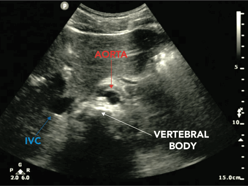 Proximal Abdominal Aorta Ultrasound Epigastric