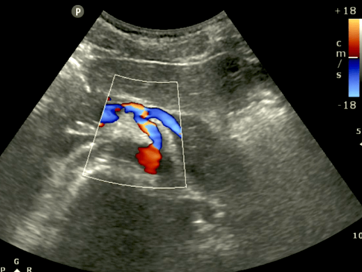 Seagull Sign Aorta Aortic Ultrasound Color Doppler