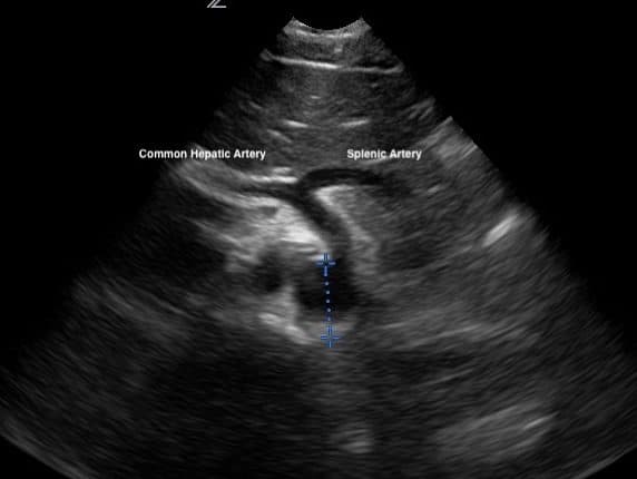 Seagull Sign Aorta Aortic Ultrasound