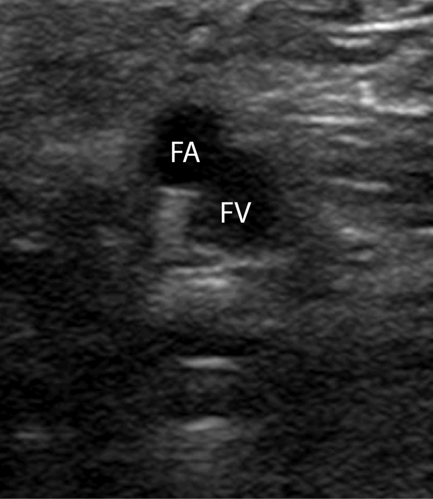 Superficial Femoral Vein DVT Ultrasound Normal