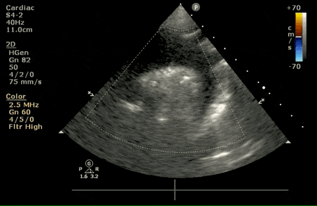 Suprasternal Notch View Ultrasound Color Doppler