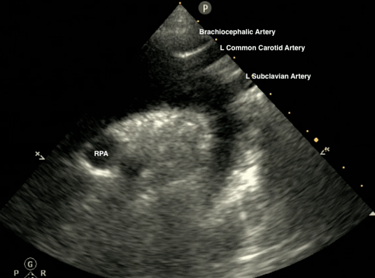 Suprasternal Notch View Ultrasound