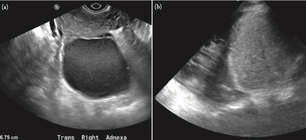 Ultrasound Endometriosis