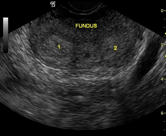 Bicornuate Uterus - Pelvic Utlrasound Gynecology