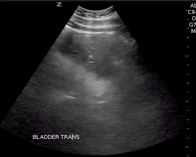 Bladder Mass Ultrasound Transverse View