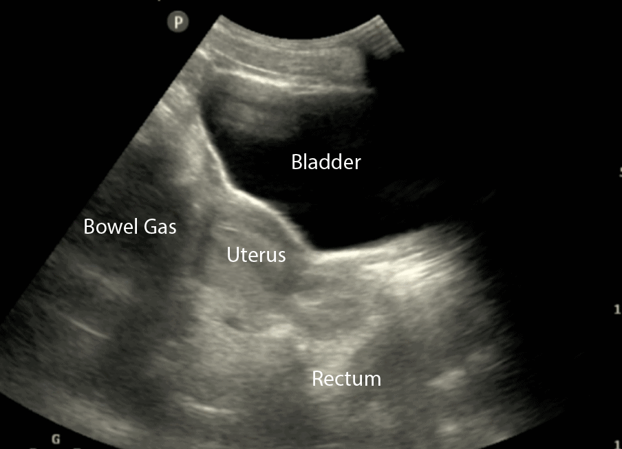 Bladder Ultrasound - Female Longitudinal