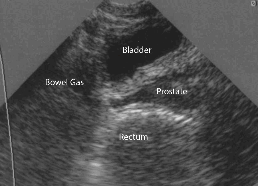 Bladder-Ultrasound-Male-Longitudinal