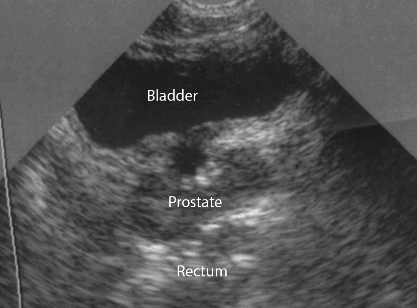 Bladder Ultrasound - Male Transverse