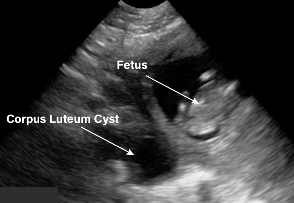 Gynecology/Pelvic Ultrasound Made Easy: Step-By-Step Guide - POCUS 101