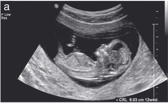 ultrasound types