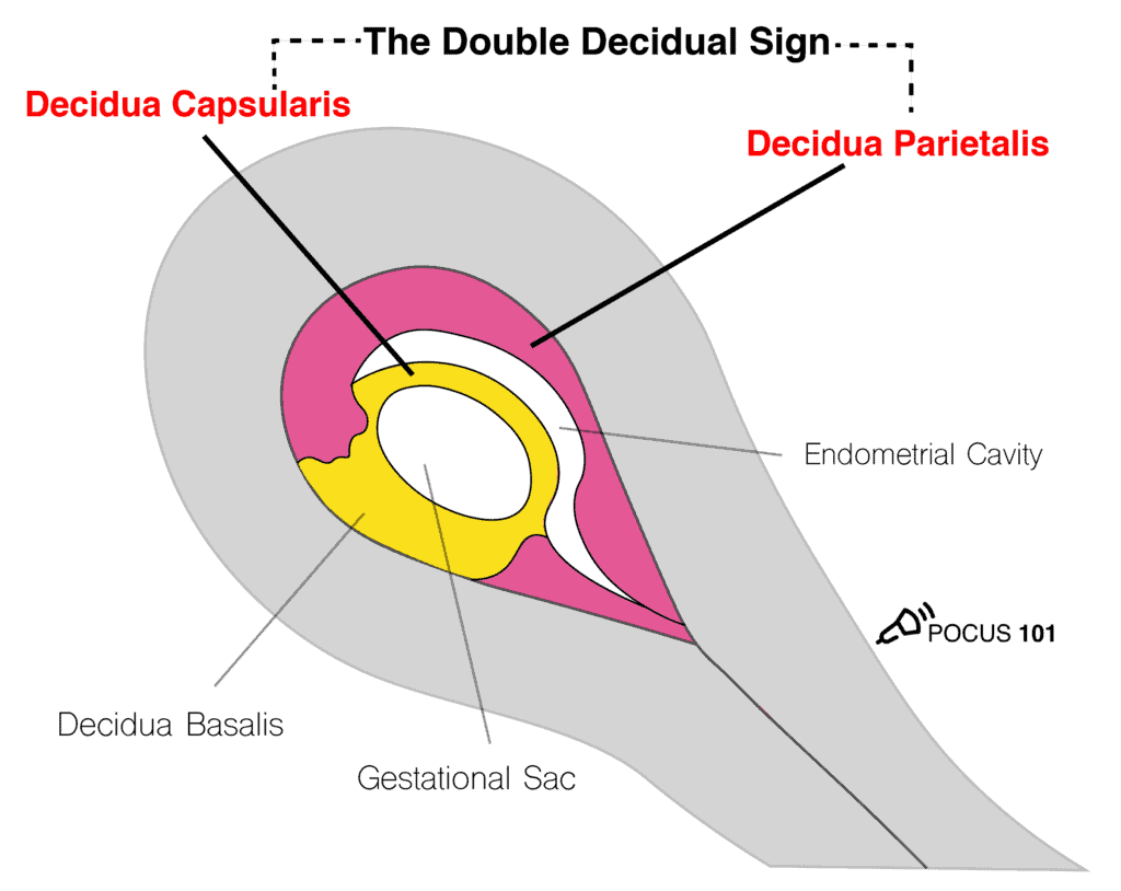 Double Decidual Sign OB Obstetric Obstetrical Ultrasound Illustration