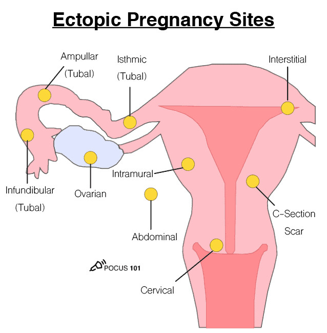 Ectopic Pregnancy Sites OB Obstetric Obstetrical Ultrasound