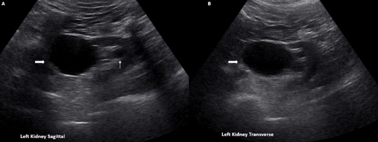 Extrarenal Pelvis Renal Ultrasound