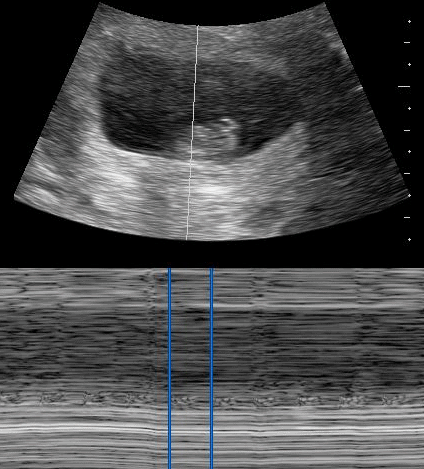 Fetal heart rate measurement FHR OB Obstetric Obstetrical Ultrasound