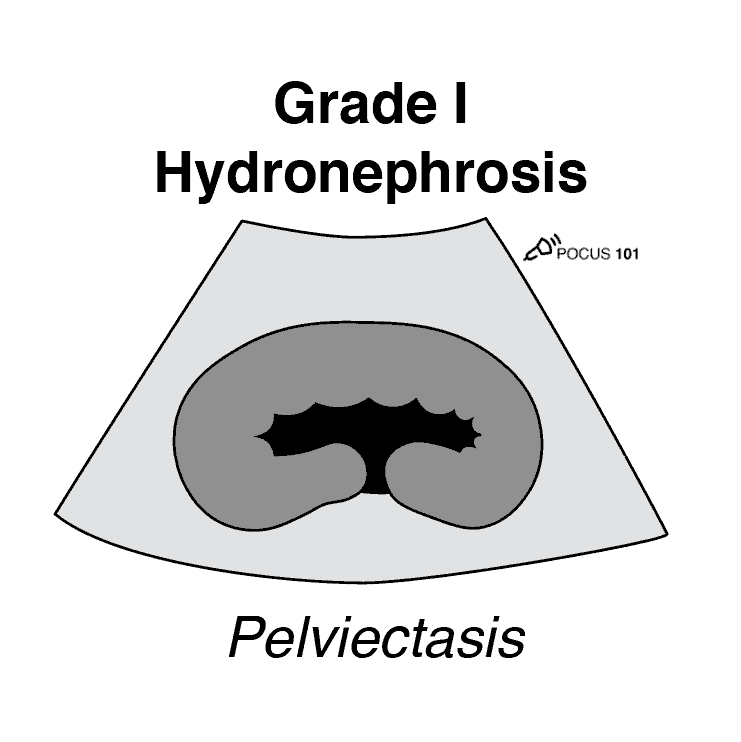 Grade 1 Hydronephrosis Pelviectasis Renal Ultrasound Mild