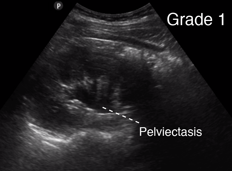 Grade 1 Hydronephrosis Renal Ultrasound - Labeled