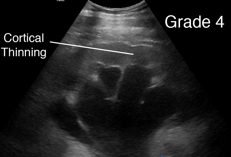 Grade 4 Hydronephrosis Renal Ultrasound - Labeled