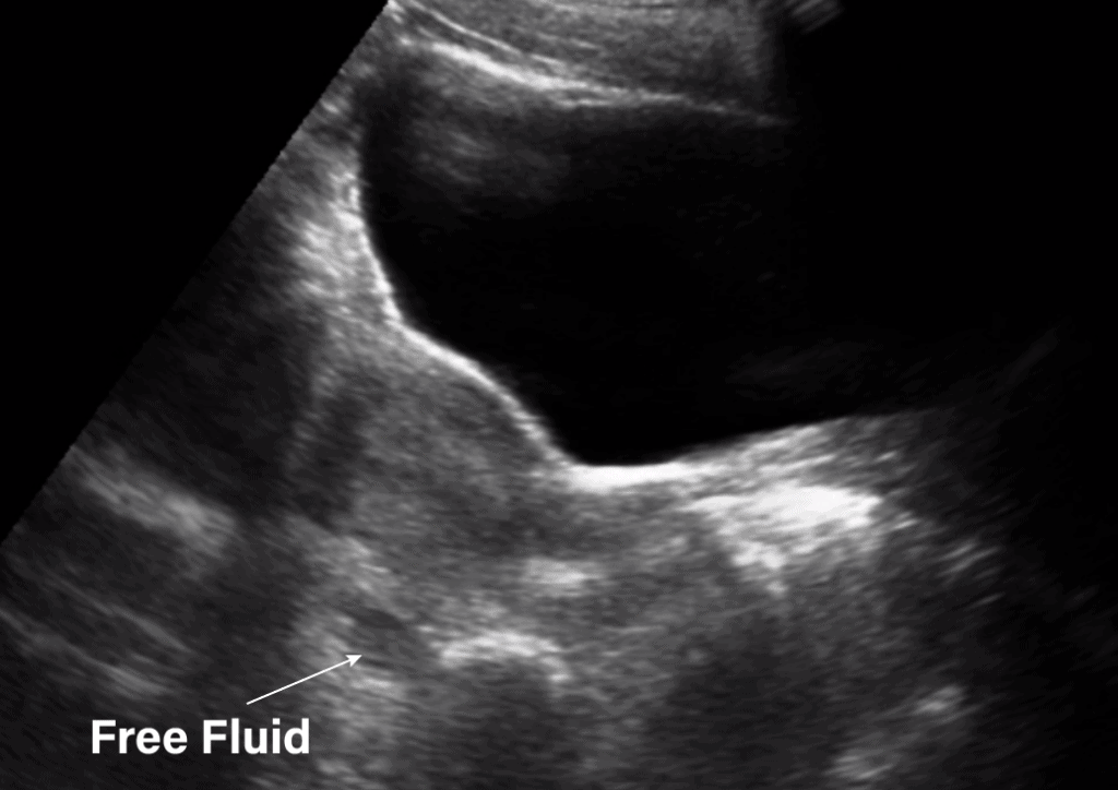 Gynecology Pelvic Ultrasound Normal Free Fluid Sagittal View