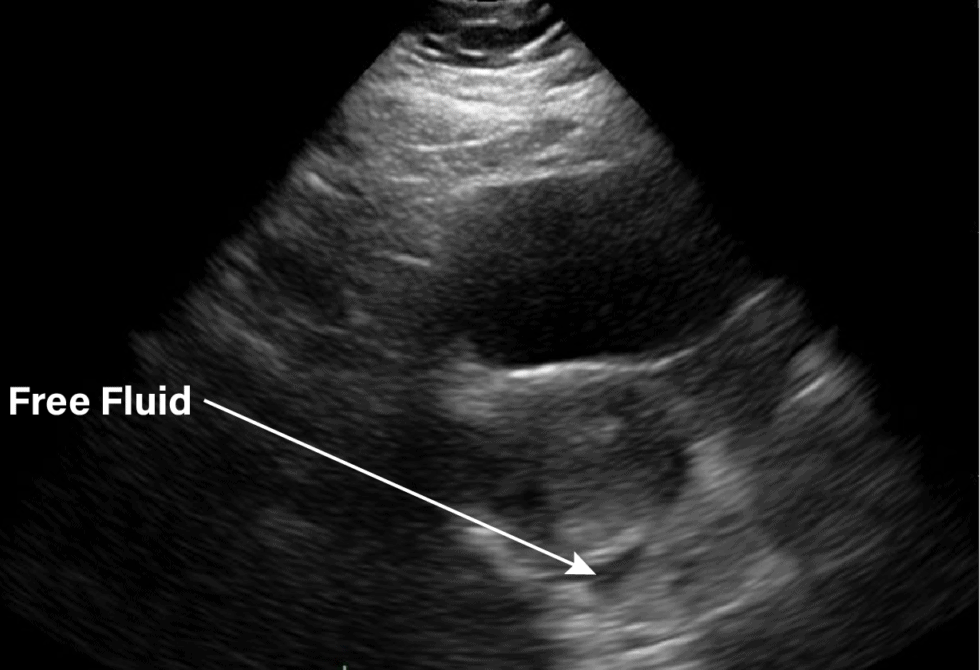 Gynecology Pelvic Ultrasound Normal Free Fluid Transverse View