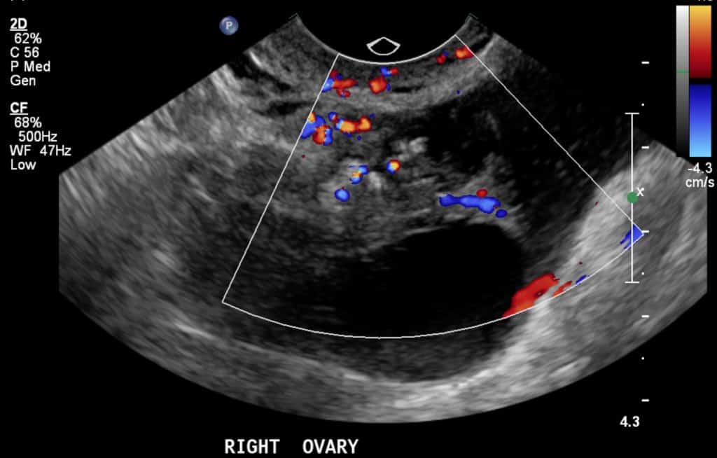 Gynecology cancer malignancy Pelvic Ultrasound serous ovarian cystadenocarcinoma