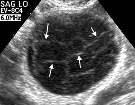 Hemorrhagic Cyst with Fibrin Strands and Cobweb Appearance Pelvic Ultrasound