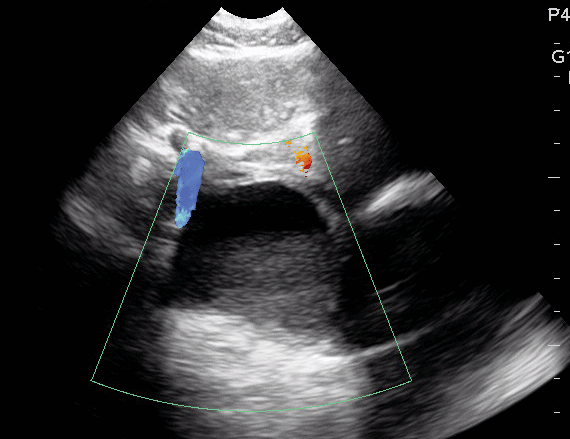 Hemorrhagic Cyst with Internal Clot Pelvic Ultrasound