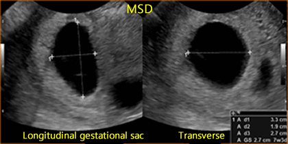 MSD Mean Sac Diameter Measurement OB Obstetric Obstetrical Ultrasound