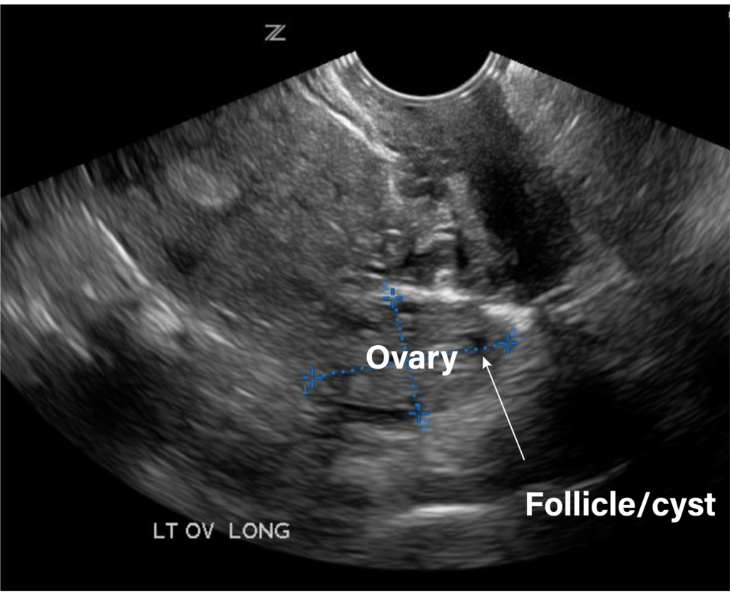 Normal Ovary Transvaginal Ultrasound Pelvic