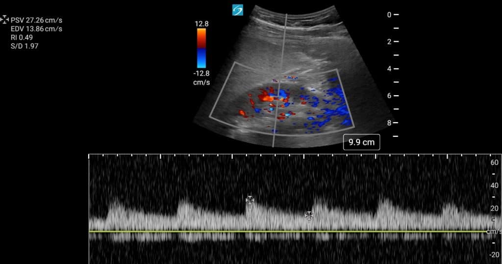 Normal Renal Doppler - Resistive Index and Venous