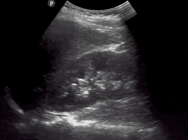 Normal Right Kidney Longitudinal View Renal Ultrasound