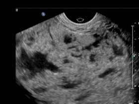 Placenta Accreta placental lacunae OB Obstetric Obstetrical Ultrasound