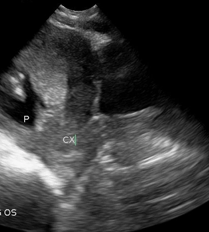 Placenta Previa OB Obstetric Obstetrical Ultrasound