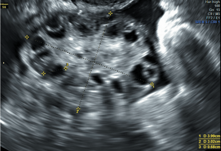 Polycystic Ovary Morphology - Gynecology Pelvic Ultrasound