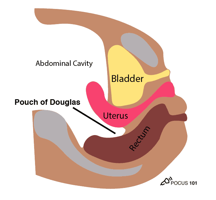 Pouch of Douglas Illustration - Pelvic Ultrasound