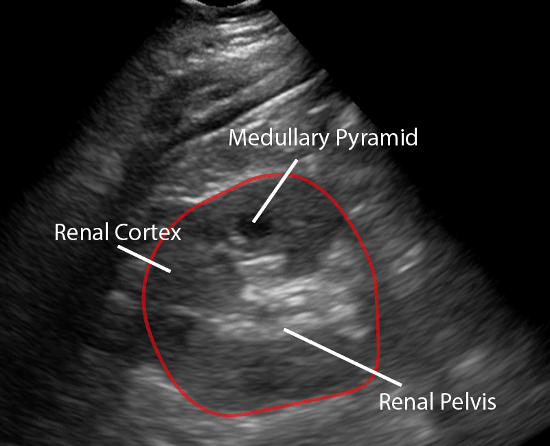 Renal Kidney Ultrasound Labeled - Normal Transverse View