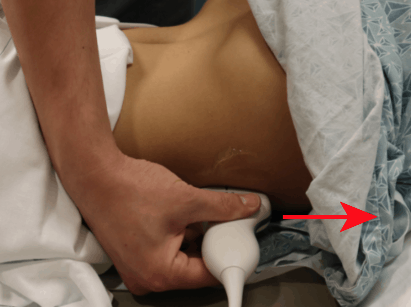 Renal Ultrasound Left Kidney Hand Position