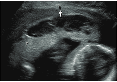 Retroplacental Placental Abruption OB Obstetric Obstetrical Ultrasound