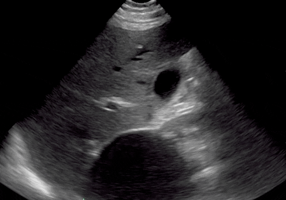 Right Renal Cyst on Kidney Ultrasound