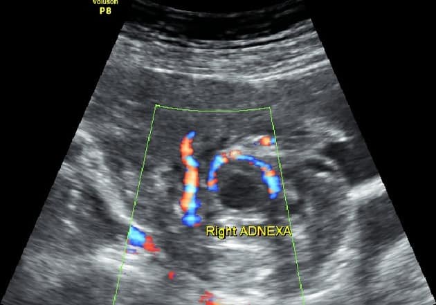 Ring of Fire Sign Ectopic Pregnancy OB Obstetric Obstetrical Ultrasound
