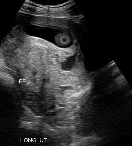 Subchorionic Placental Abruption OB Obstetric Obstetrical Ultrasound