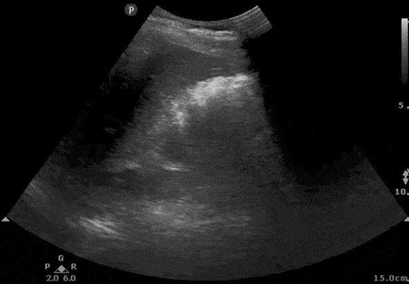 Tilting and Fanning of Kidney on Renal Ultrasound