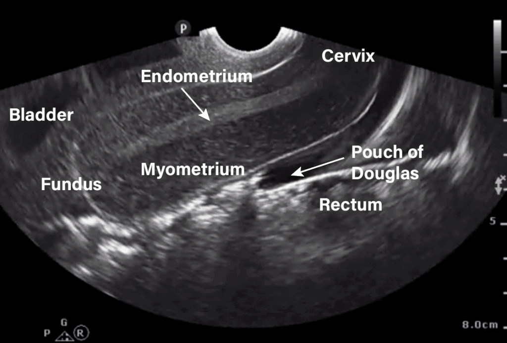 Transvaginal Ultrasound Uterus Sagittal View