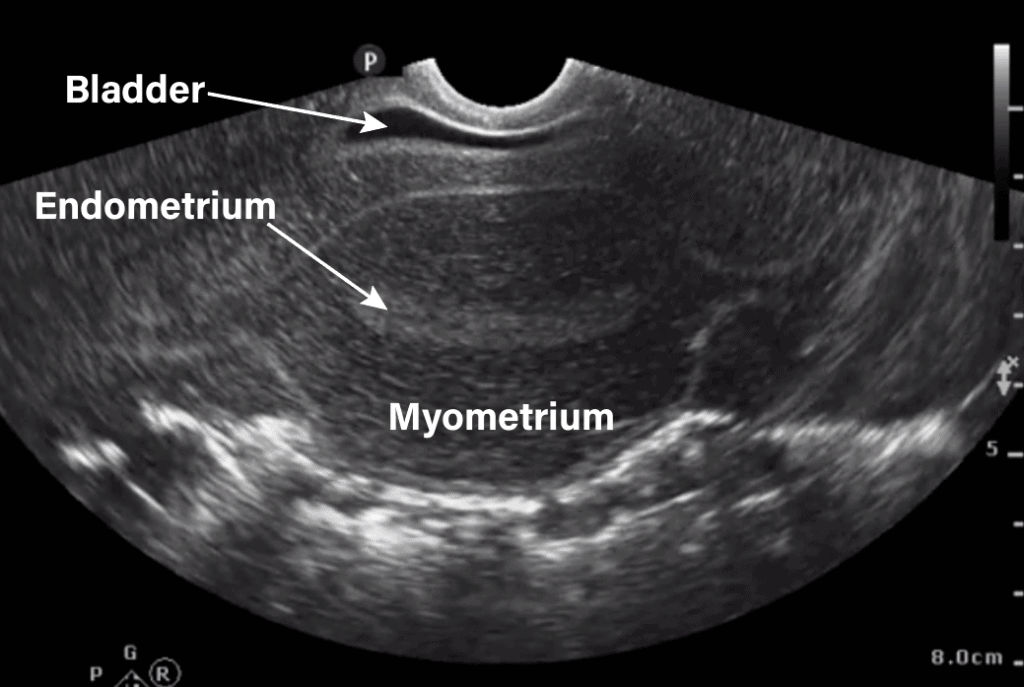 Transvaginal Ultrasound Uterus Transverse View