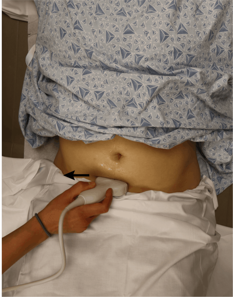 Transverse-Uterus-Probe-Position Pelvic Ultrasound