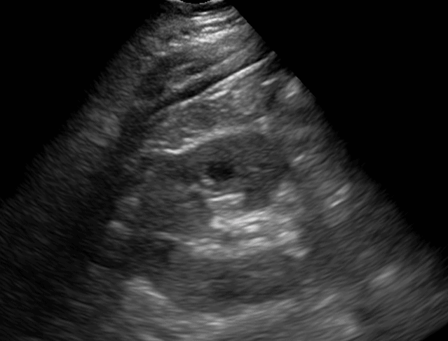 Transverse View Renal Kidney Ultrasound - Unlabeled
