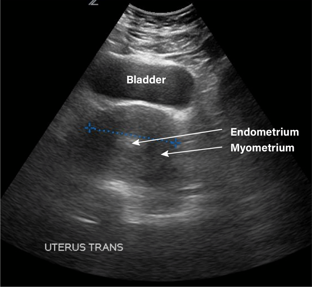 Uterus Labeled - Pelvic Ultrasound Gynecology - Transverse View