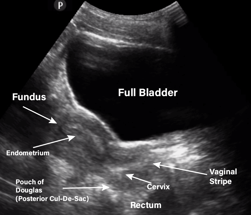 Uterus Labeled - Pelvic Ultrasound Gynecology