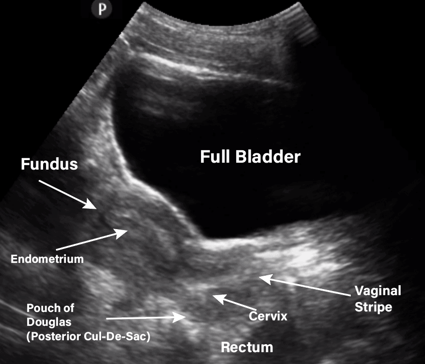 Ultrasound Evaluation Of The Uterus Radiology Key