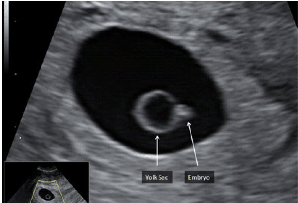 Yolk Sac with Fetal Pole Embryo OB Obstetric Obstetrical Ultrasound